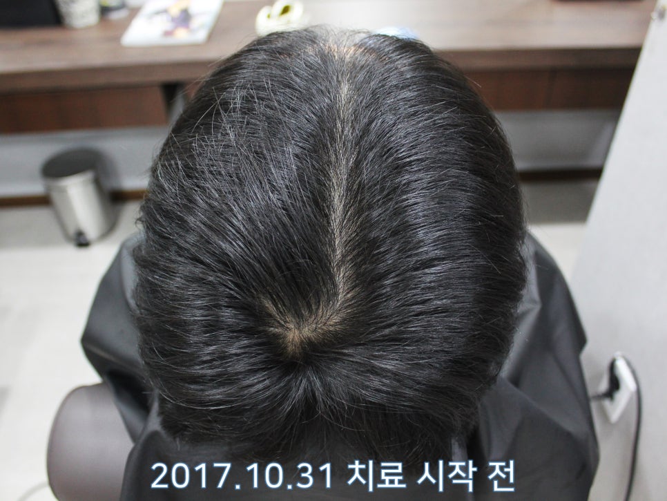 연세봄빛피부과 탈모치료 #12 (남성형탈모, 이마탈모, 정수리탈모) 관련 이미지 3