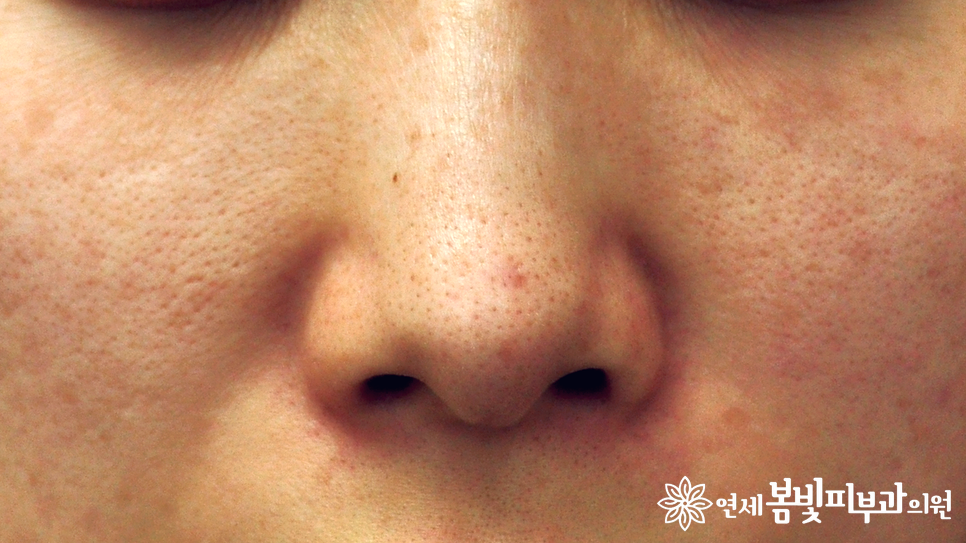모공줄이는 방법 #1 (모공이 생기는 원인, 분류, 블랙헤드, 화이트헤드, 아쿠아필, 제네시스 레이저) 관련 이미지 5
