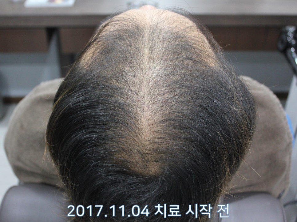 연세봄빛피부과 탈모치료 #11 (남성형탈모, 이마탈모, 정수리탈모) 관련 이미지 4