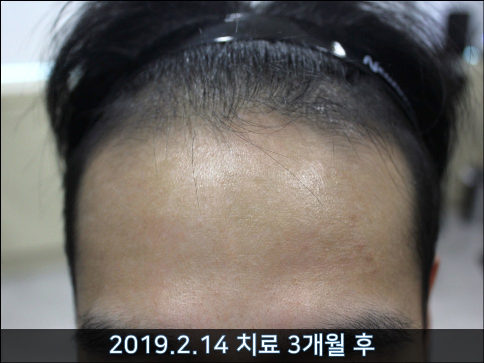 연세봄빛피부과 탈모치료 #35 (남성형탈모, 이마탈모, 가족력없음) 관련 이미지 4