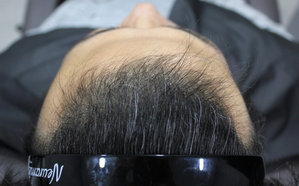 연세봄빛피부과 탈모치료 #5 (남성형탈모, 이마탈모, 정수리탈모) 관련 이미지 2