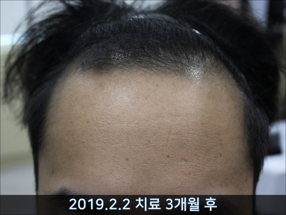 연세봄빛피부과 탈모치료 #33 (남성형탈모, 이마탈모, 정수리탈모, 가족력없음) 관련 이미지 4