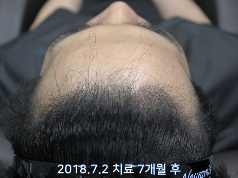 연세봄빛피부과 탈모치료 #13 (남성형탈모, 이마탈모) 관련 이미지 3