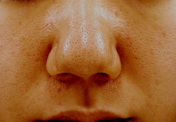 모공줄이는 방법 #2 (정상 모공과 넓어진 모공의 차이, 모공이 넓어지는 원인, 시크릿 레이저, 물광주사, 나노 크로스) 관련 이미지 3