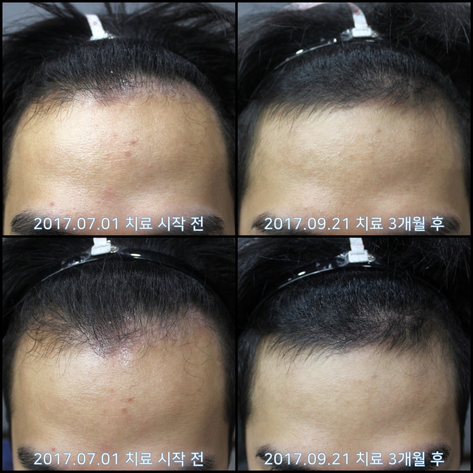 연세봄빛피부과 탈모치료 #14 (남성형탈모, 이마탈모) 관련 이미지 5