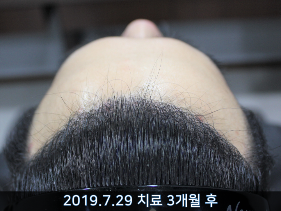 연세봄빛피부과 탈모치료 #34 (남성형탈모, 모발이식 후 치료) 관련 이미지 2