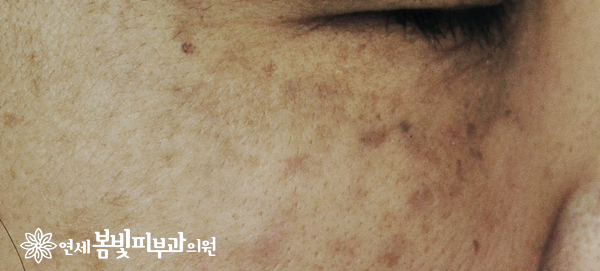 다크써클 없애는법 #2 (다크써클의 치료: 바르는 약, 미백크림, 미백크림효과) 관련 이미지 2