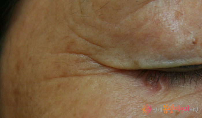 보톡스 바르게 알기 #3 (보톡스 맞고 예뻐지기, 보톡스 시술이 가능한 부위, 이마 주름, 미간 주름, 눈가 주름, 눈밑 주름, 콧잔등 주름, 입가 주름, 사각턱, 종아리, 윤곽술 관련 이미지 4