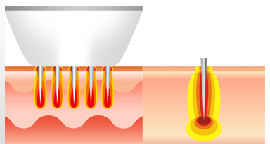 니들 프락셀 시크릿레이저 도입! (모공줄이는방법, 여드름흉터없애는법) 관련 이미지 2