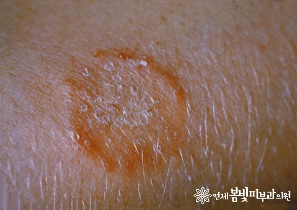 길냥이 엄마들에게 찾아오는 불청객, 링웜! 관련 이미지 2