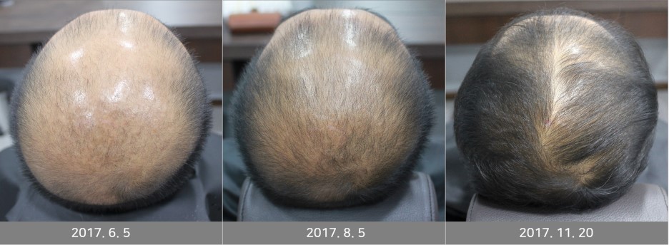 연세봄빛피부과 탈모치료 예시 (남성형탈모, 정수리탈모) 관련 이미지 9