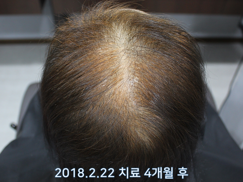 연세봄빛피부과 탈모치료 #6 (여성형탈모, 정수리탈모) 관련 이미지 2
