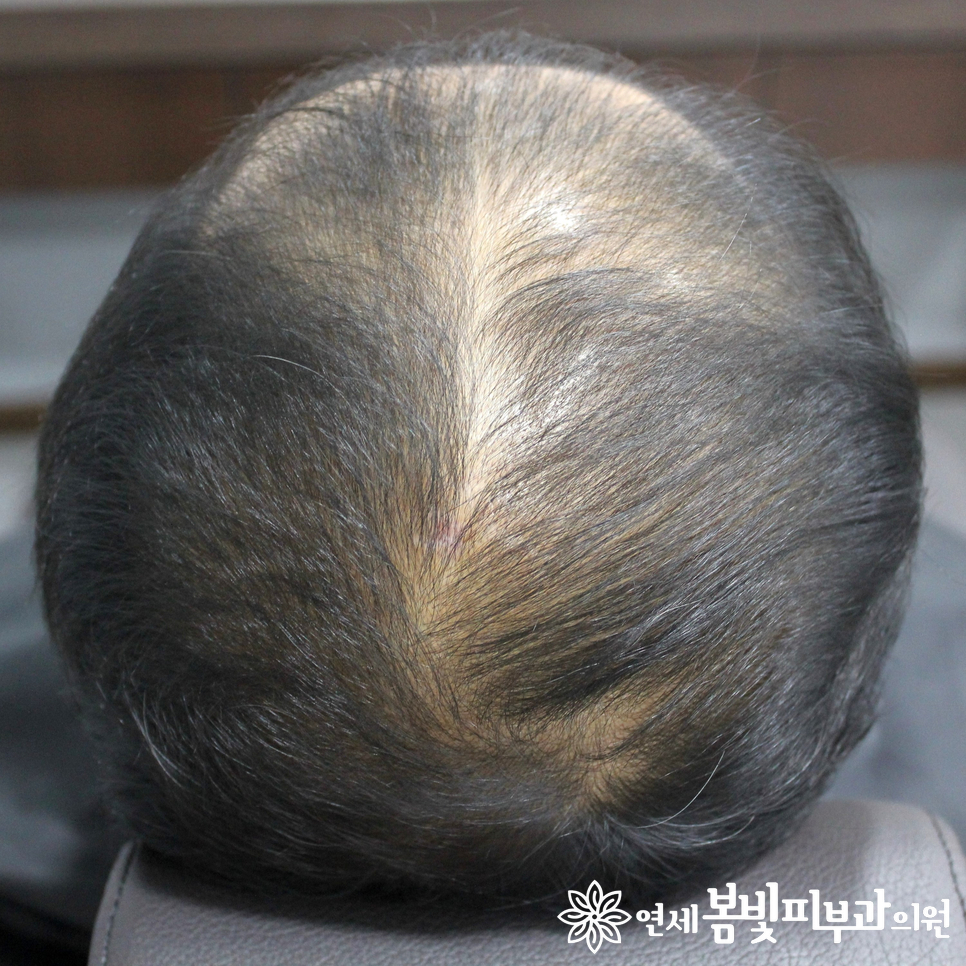 연세봄빛피부과 탈모치료 예시 (남성형탈모, 정수리탈모) 관련 이미지 6