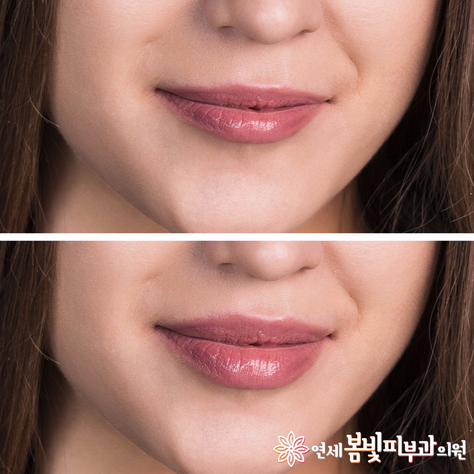 입술 필러로 티 안나게 예뻐지기~ 관련 이미지 2