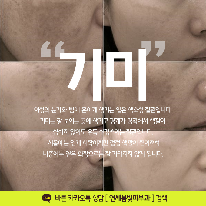 기미잡티치료로 피부하얘지는 법, 얼굴하얘지는법 (레이저토닝, 레이저토닝 효과) 관련 이미지 2