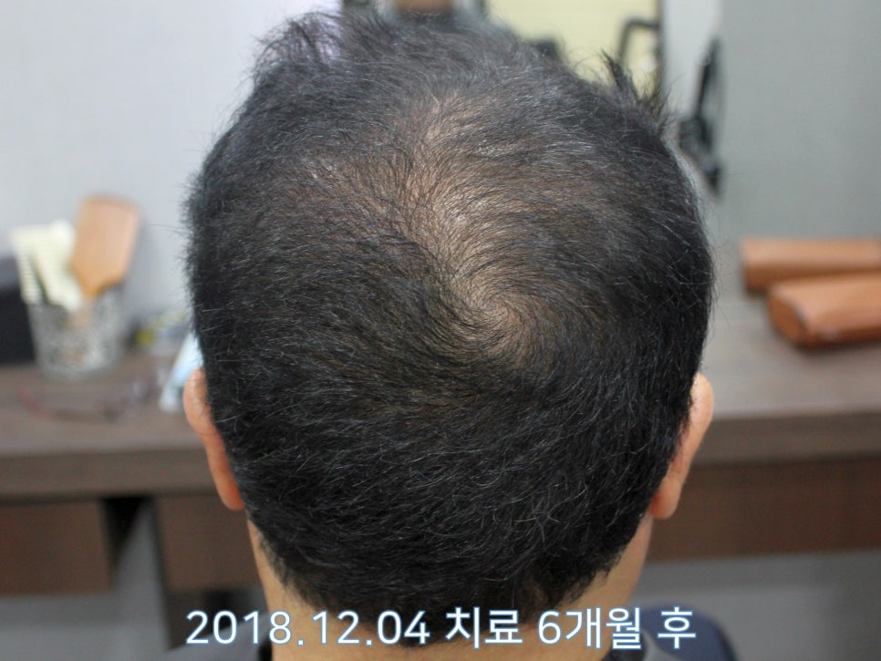 연세봄빛피부과 탈모치료 #16 (남성형탈모, 이마탈모, 정수리탈모, 3단계) 관련 이미지 6