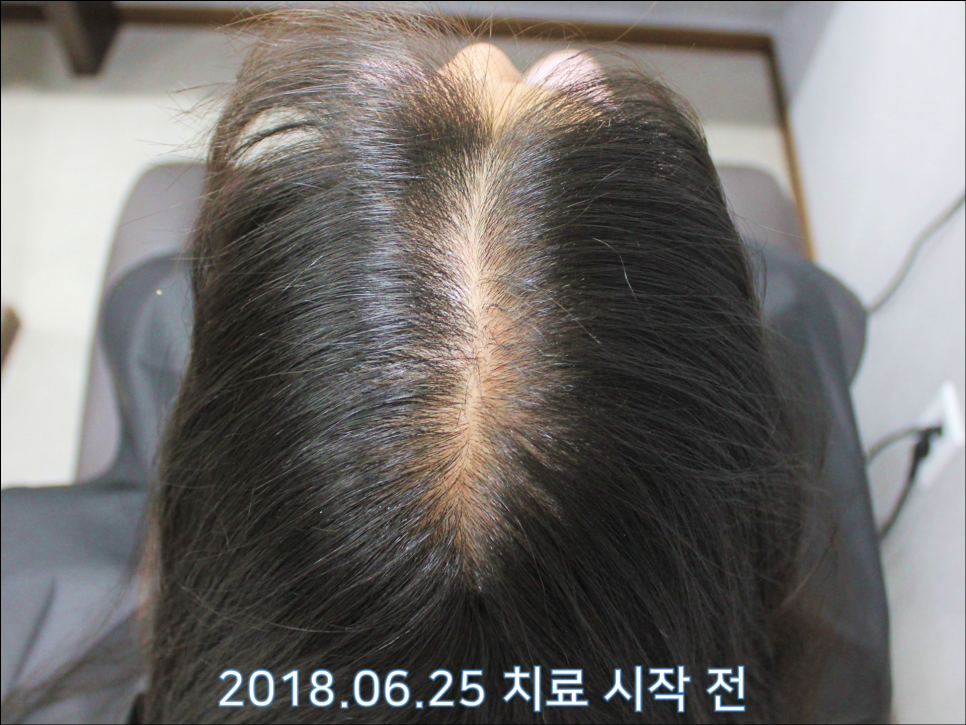 연세봄빛피부과 탈모치료 #24 (여성형 탈모, 이마탈모, 정수리탈모) 관련 이미지 6