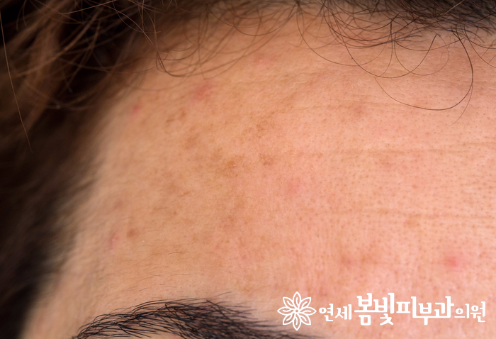 여드름, 지성 피부에도 문제없는 ASF 피지컬 선블럭 관련 이미지 2