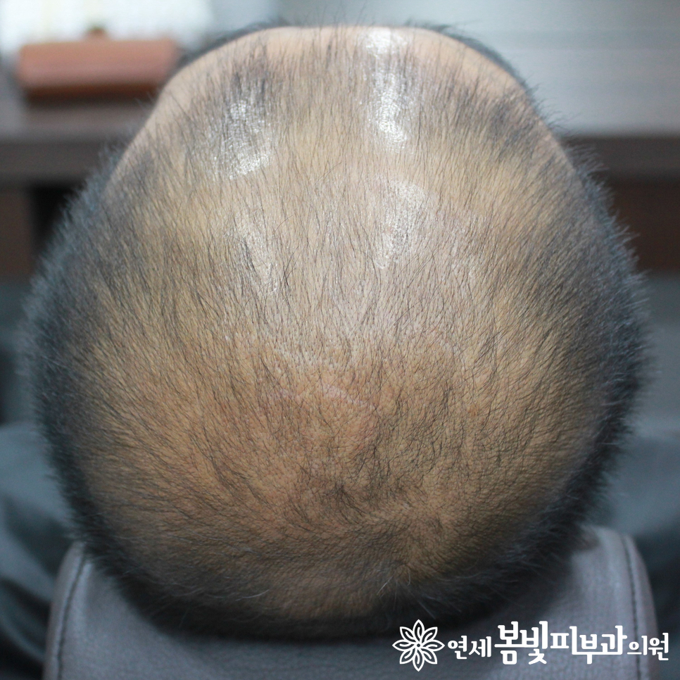 연세봄빛피부과 탈모치료 예시 (남성형탈모, 정수리탈모) 관련 이미지 4
