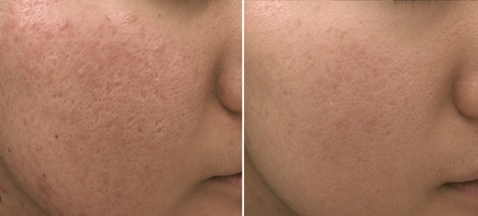 연세봄빛피부과 크로스치료 안내 (모공, 흉터, 여드름흉터치료) 관련 이미지 1