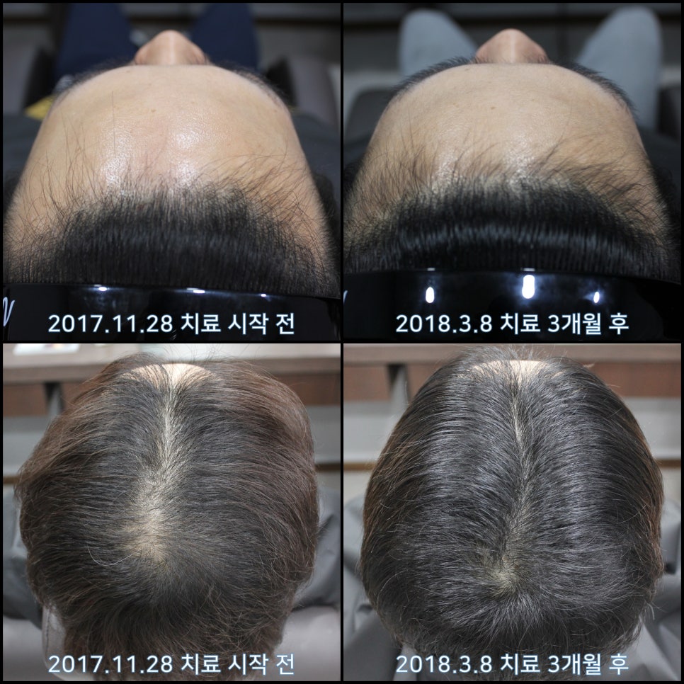 연세봄빛피부과 탈모치료 #7 (남성형탈모, 이마탈모, 정수리탈모) 관련 이미지 5