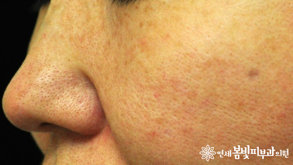 모공줄이는 방법 #1 (모공이 생기는 원인, 분류, 블랙헤드, 화이트헤드, 아쿠아필, 제네시스 레이저) 관련 이미지 6