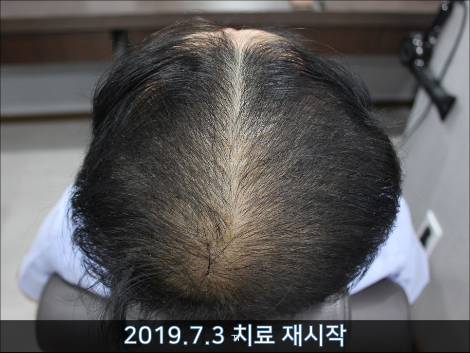 연세봄빛피부과 탈모치료 #39 (남성형탈모, 치료 중단 후 재치료) 관련 이미지 3