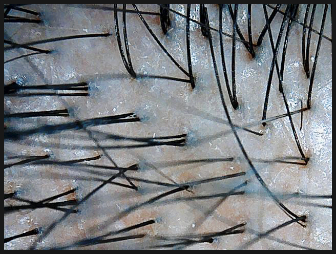 연세봄빛피부과 탈모치료 예시 (남성형탈모, 정수리탈모) 관련 이미지 3