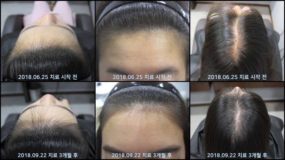 연세봄빛피부과 탈모치료 #24 (여성형 탈모, 이마탈모, 정수리탈모) 관련 이미지 8