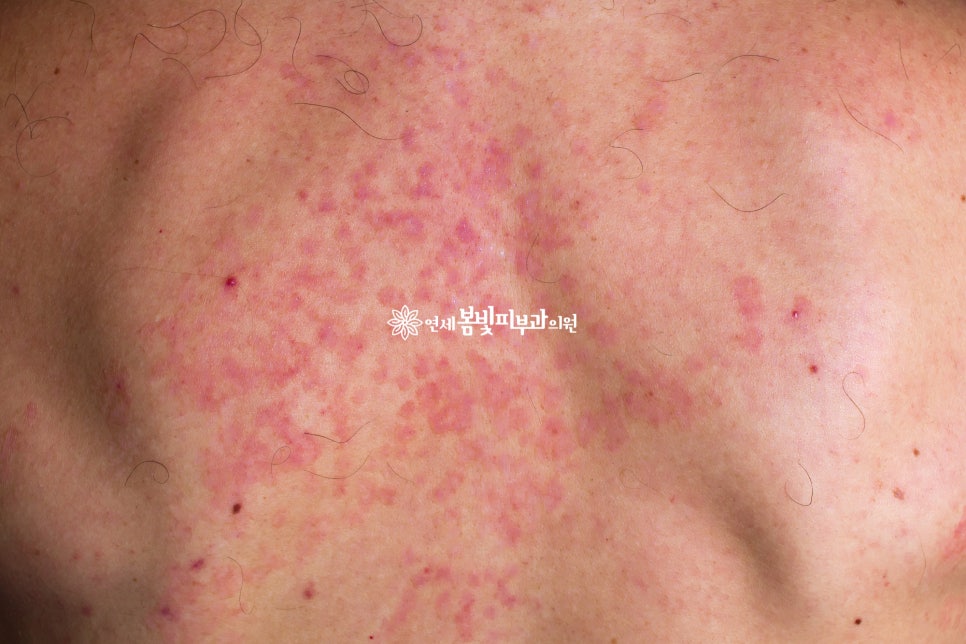 땀과 피부질환 관련 이미지 4