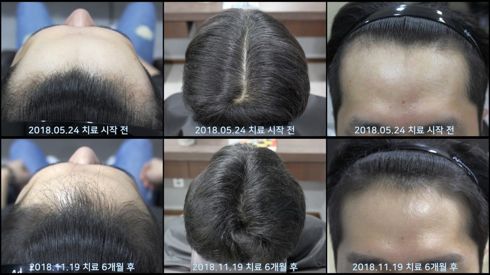 연세봄빛피부과 탈모치료 #22 (남성형탈모, 이마탈모) 관련 이미지 7