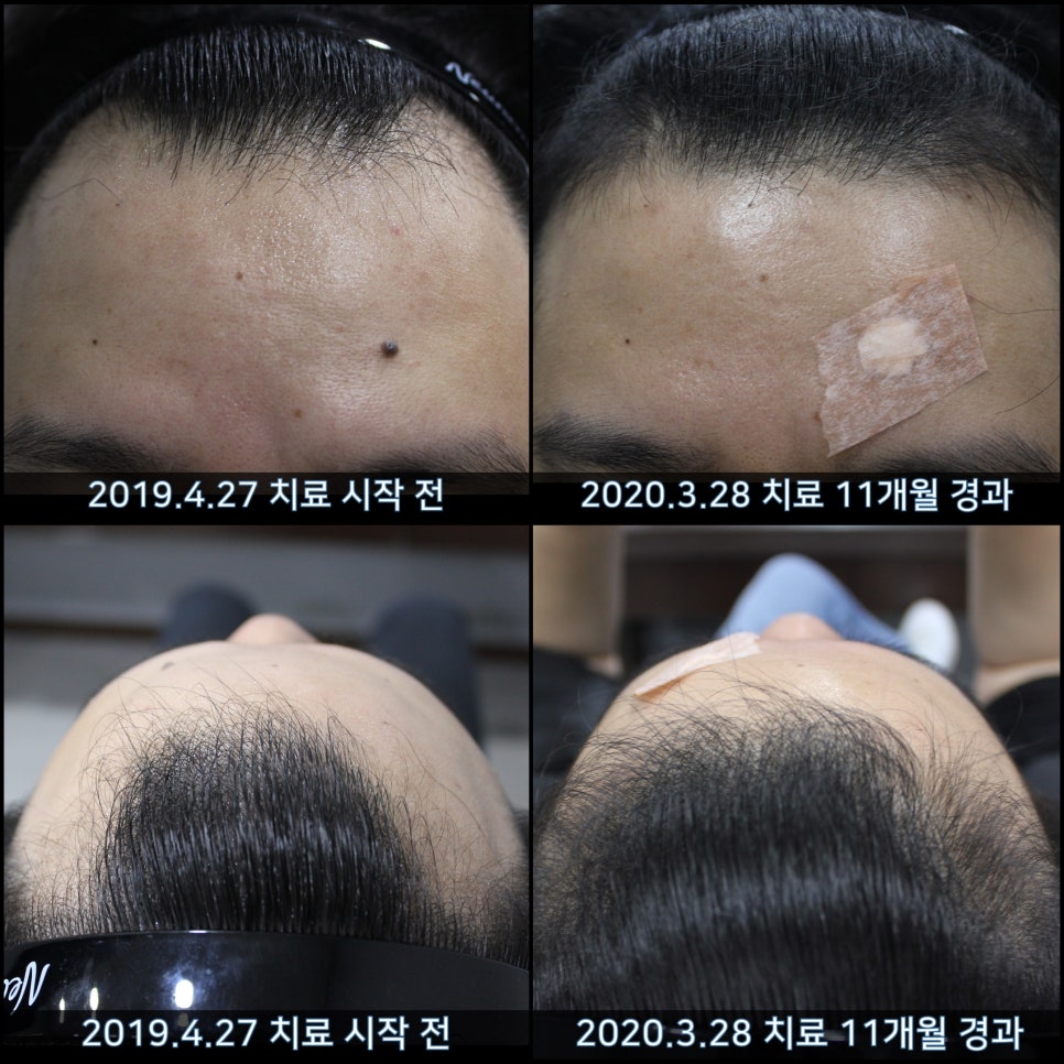 연세봄빛피부과 탈모치료 #42 (남성형탈모,M자탈모) 관련 이미지 1