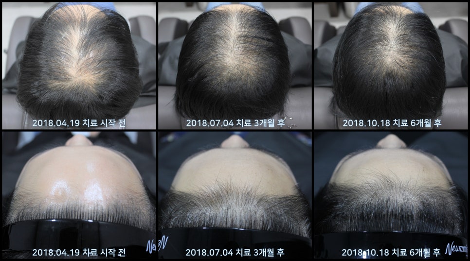연세봄빛피부과 탈모치료 #21 (여성형탈모, 이마탈모) 관련 이미지 10