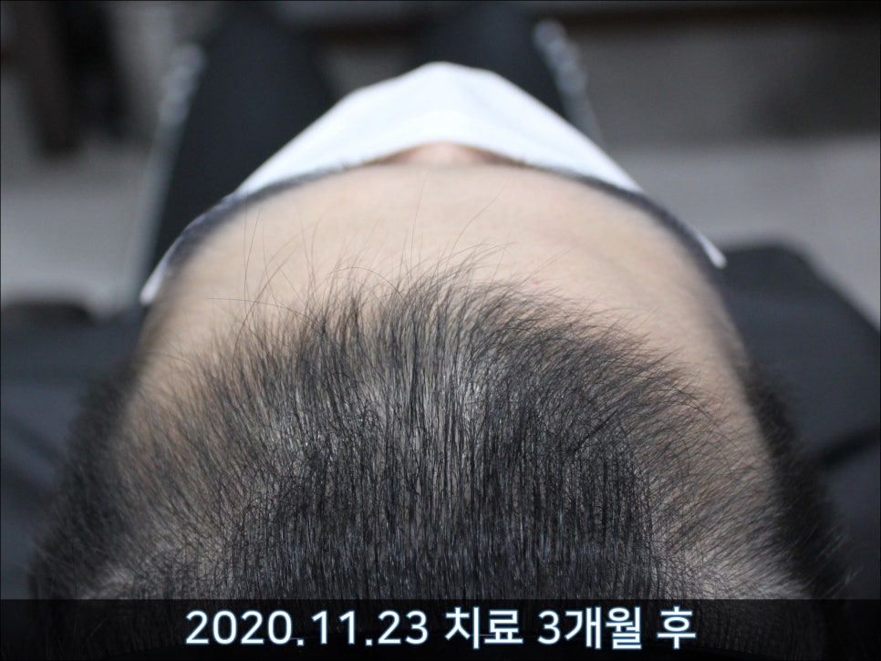 연세봄빛피부과 탈모치료 #32 (남성형탈모, 이마탈모, 정수리탈모, 두피보톡스) 관련 이미지 4