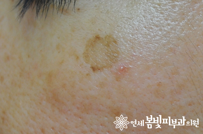 다양한 얼굴 색소 치료 #2 (흑자 없애는법, 검버섯 없애는법) 관련 이미지 2