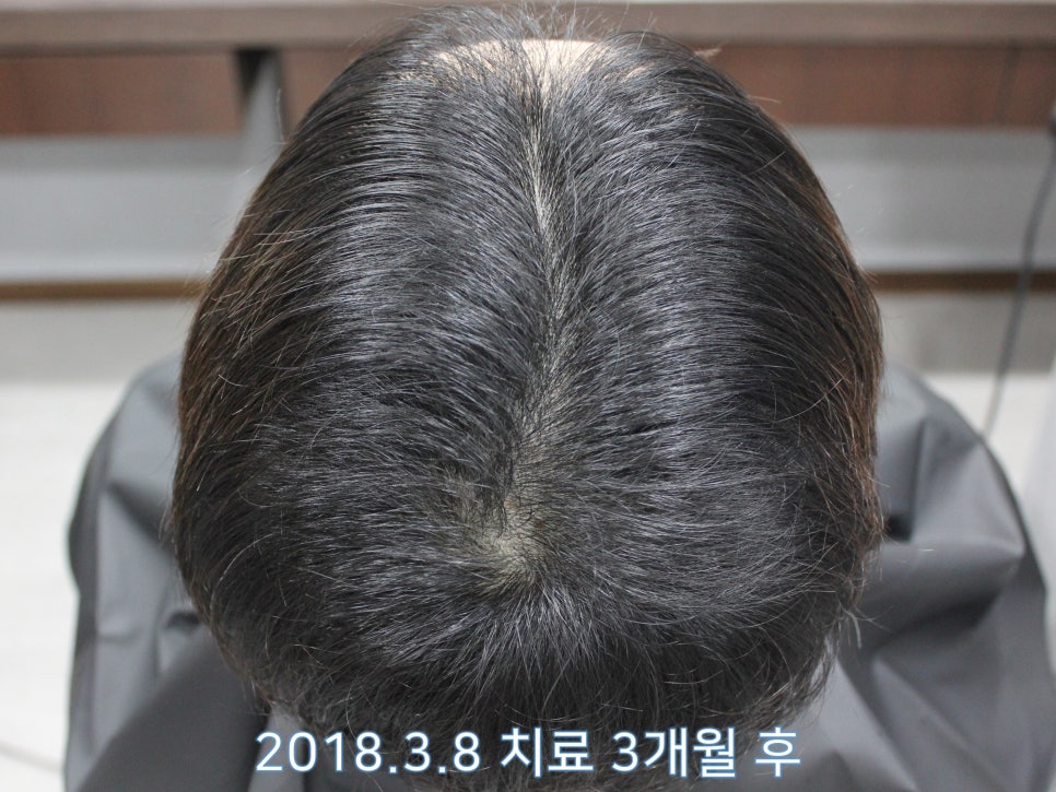 연세봄빛피부과 탈모치료 #7 (남성형탈모, 이마탈모, 정수리탈모) 관련 이미지 4