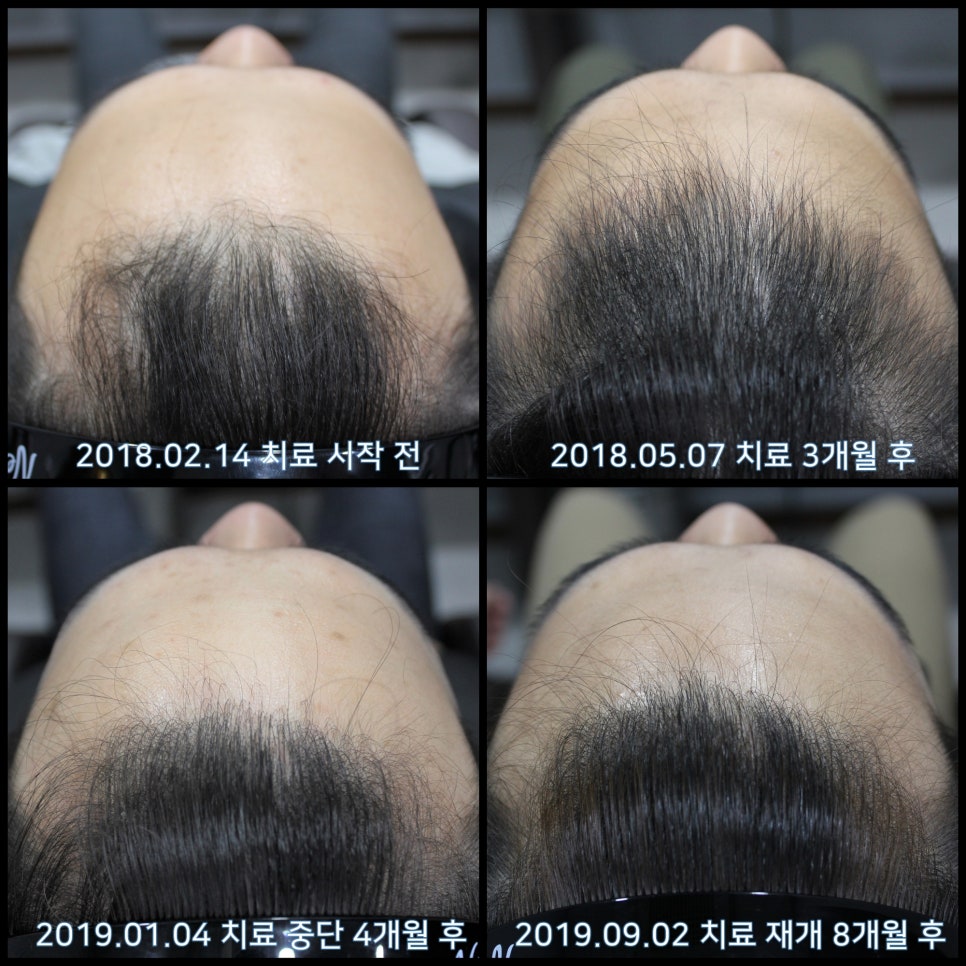 연세봄빛피부과 탈모치료 #25 (남성형탈모, 재치료, 이마탈모, 정수리탈모) 관련 이미지 10
