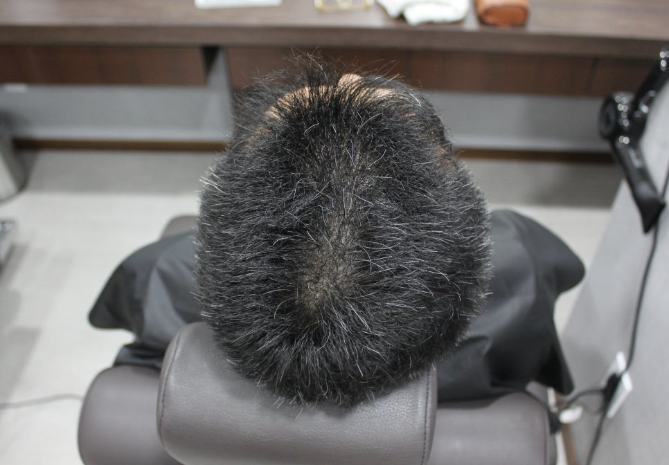 연세봄빛피부과 탈모치료 #4-1 (남성형탈모, 이마탈모, 정수리탈모, 6개월치료 경과 업데이트) 관련 이미지 6