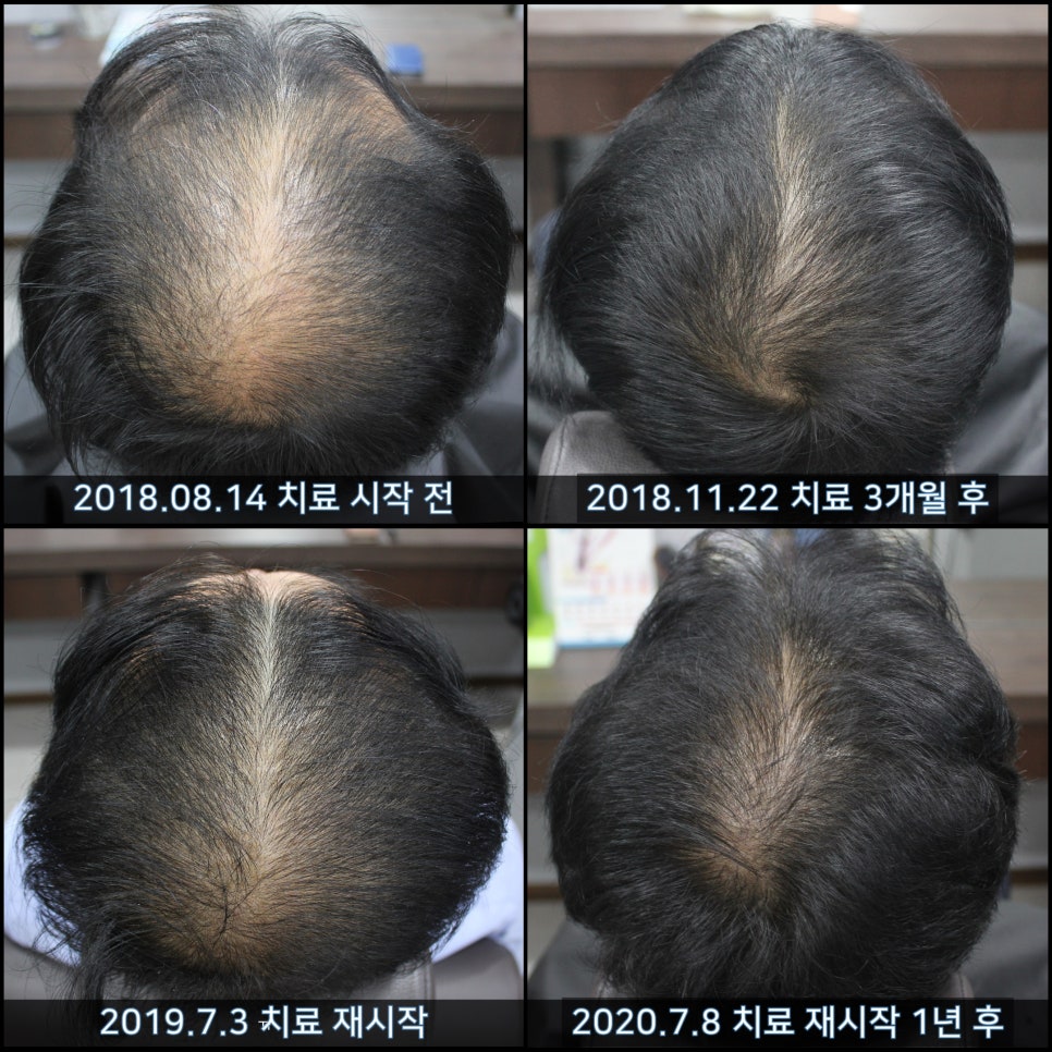 연세봄빛피부과 탈모치료 #39 (남성형탈모, 치료 중단 후 재치료) 관련 이미지 5