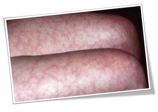 혈액순환 장애로 생기는 그물 울혈반과 레이노드증후군 관련 이미지 1