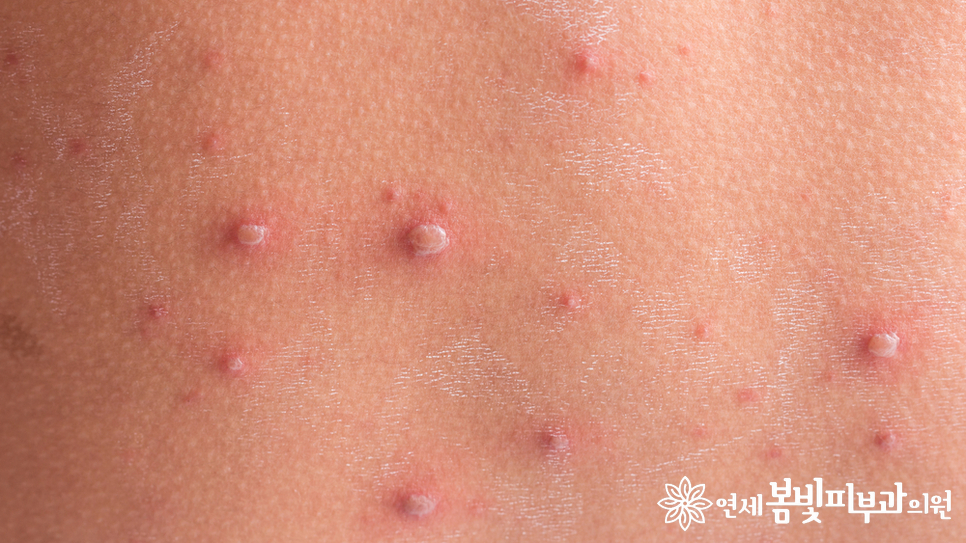 수두 예방접종을 했는데도 수두에 걸릴 수 있나요? (수두, chickenpox, 바이러스성 피부질환, 피부질환 잘 보는 피부과) 관련 이미지 2