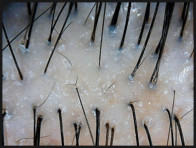 연세봄빛피부과 탈모치료 #2 (남성형탈모, 이마탈모, 정수리탈모) 관련 이미지 2