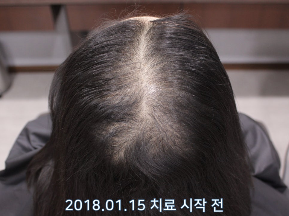 연세봄빛피부과 탈모치료 #10 (여성형탈모, 정수리탈모) 관련 이미지 1