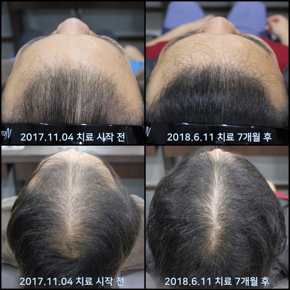 연세봄빛피부과 탈모치료 #11 (남성형탈모, 이마탈모, 정수리탈모) 관련 이미지 7