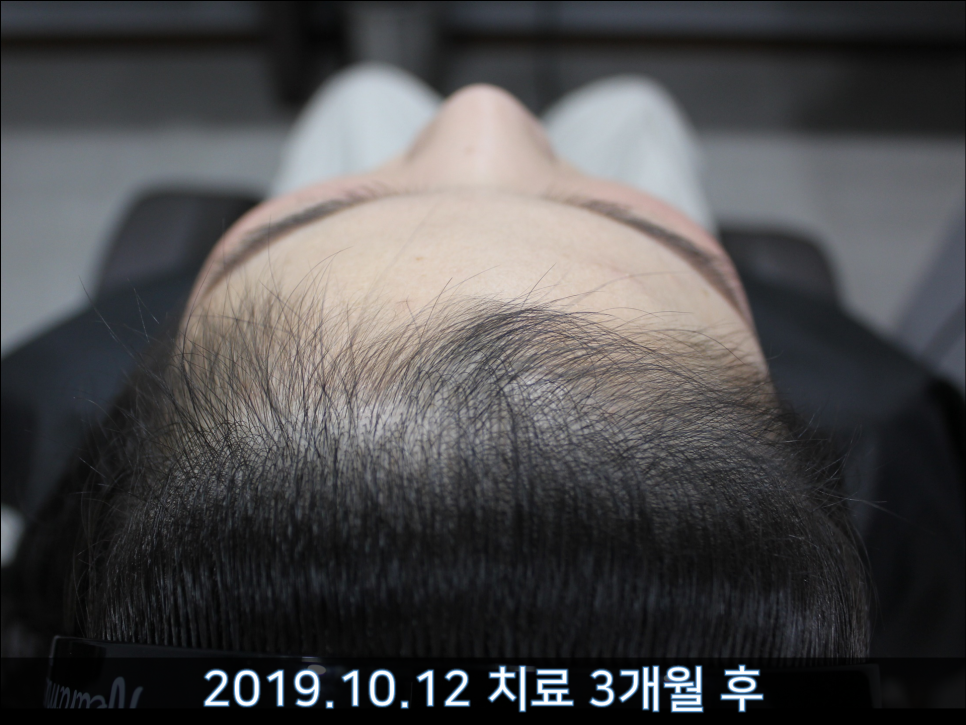 연세봄빛피부과 탈모치료 #38 (여성형탈모, 여성이마탈모) 관련 이미지 4