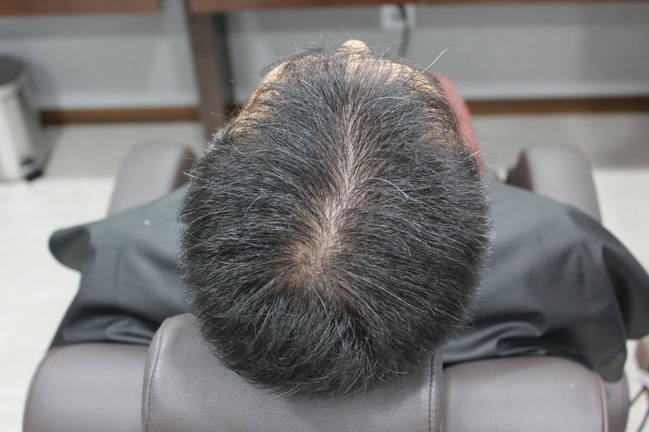 연세봄빛피부과 탈모치료 #4-1 (남성형탈모, 이마탈모, 정수리탈모, 6개월치료 경과 업데이트) 관련 이미지 4