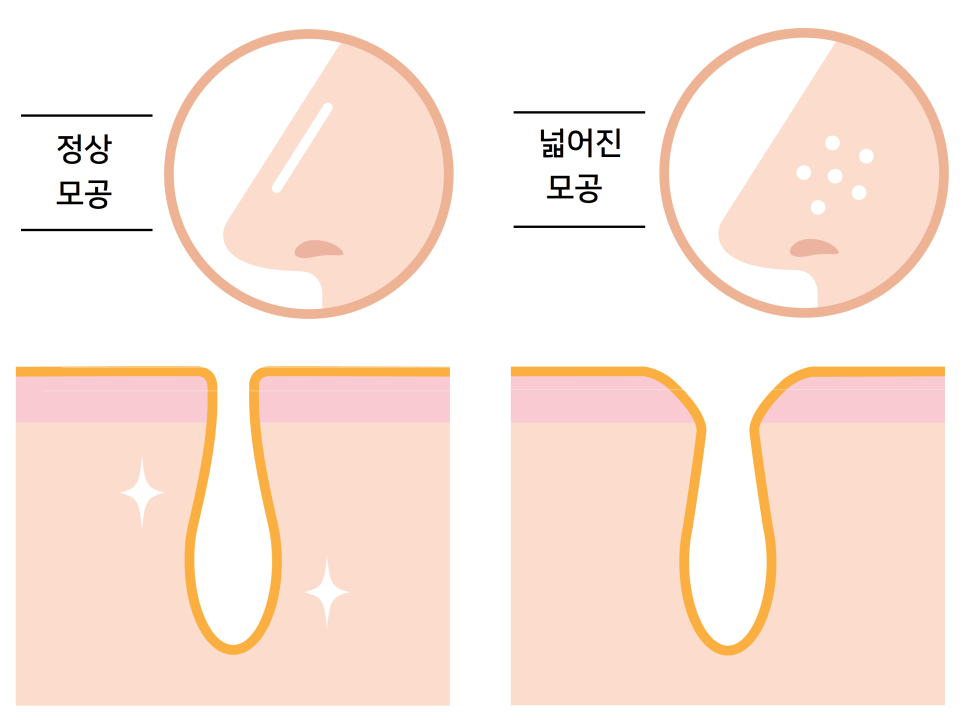 모공줄이는 방법 #2 (정상 모공과 넓어진 모공의 차이, 모공이 넓어지는 원인, 시크릿 레이저, 물광주사, 나노 크로스) 관련 이미지 2