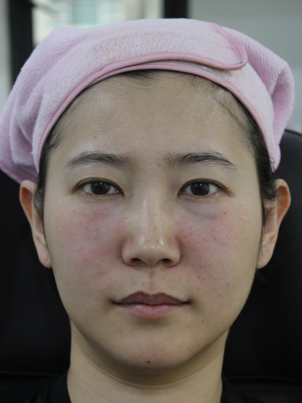 동안필러 치료 예시 #5 관련 이미지 2