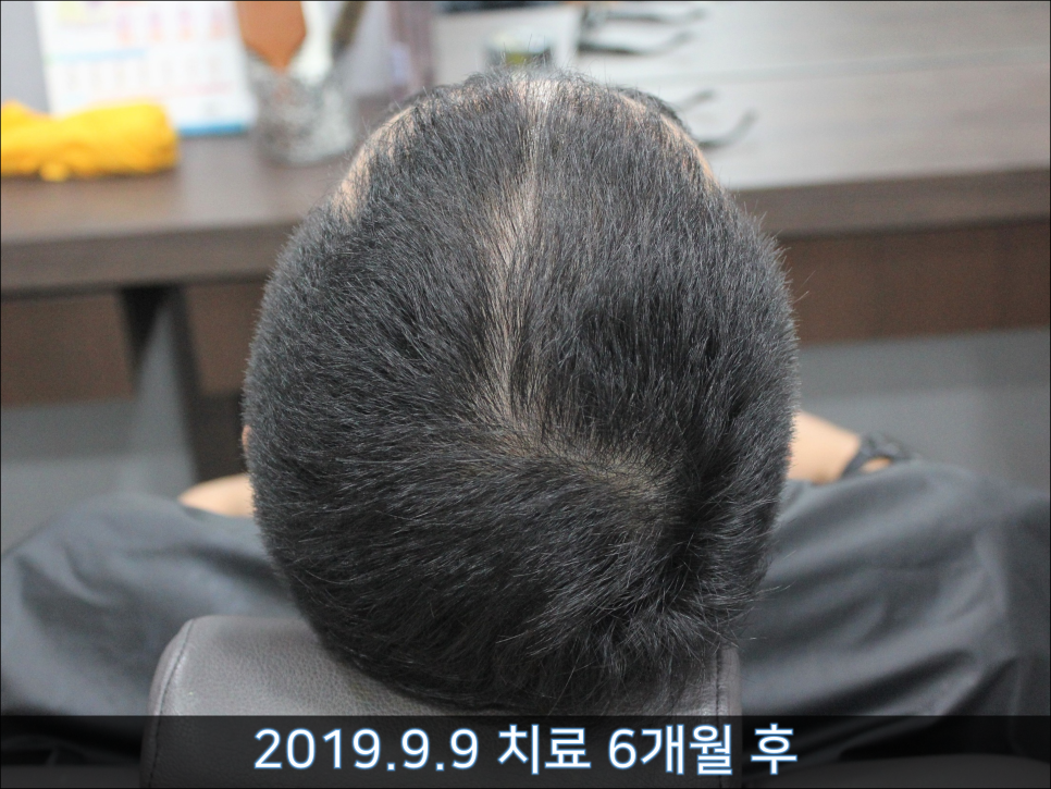 연세봄빛피부과 탈모치료 #41 (남성형탈모, 정수리탈모) 관련 이미지 3