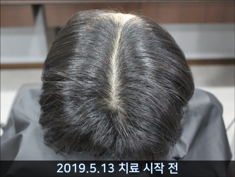 연세봄빛피부과 탈모치료 #34 (남성형탈모, 모발이식 후 치료) 관련 이미지 3